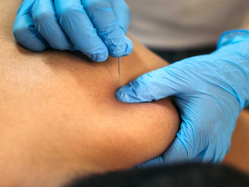 Acupuncture-All Health Chiropractic Acupuncture-All Health Chiropractic