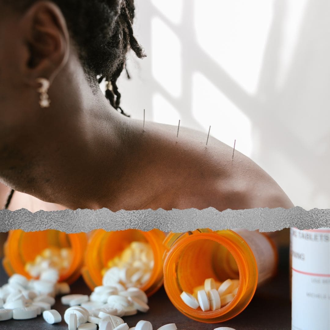 Acupuncture Vs Pain Meds