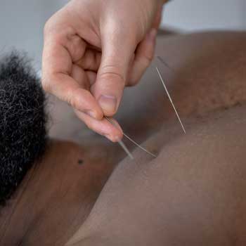 Acupuncture services