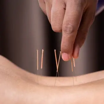 Six acupuncture needles placed in a patient's spine.