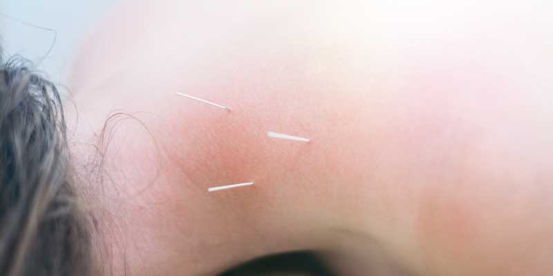 A neck with three acupuncture needles.