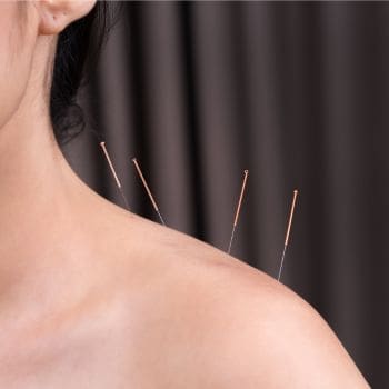 Photo of a female's left should with four acupuncture needles